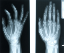 xray of hand