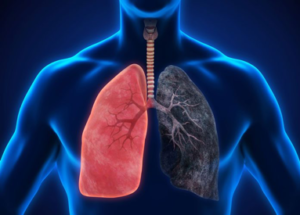 lungs affected by COPD